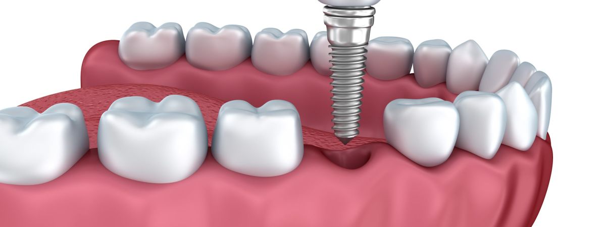 Welches Material wird für Zahnimplantate verwendet